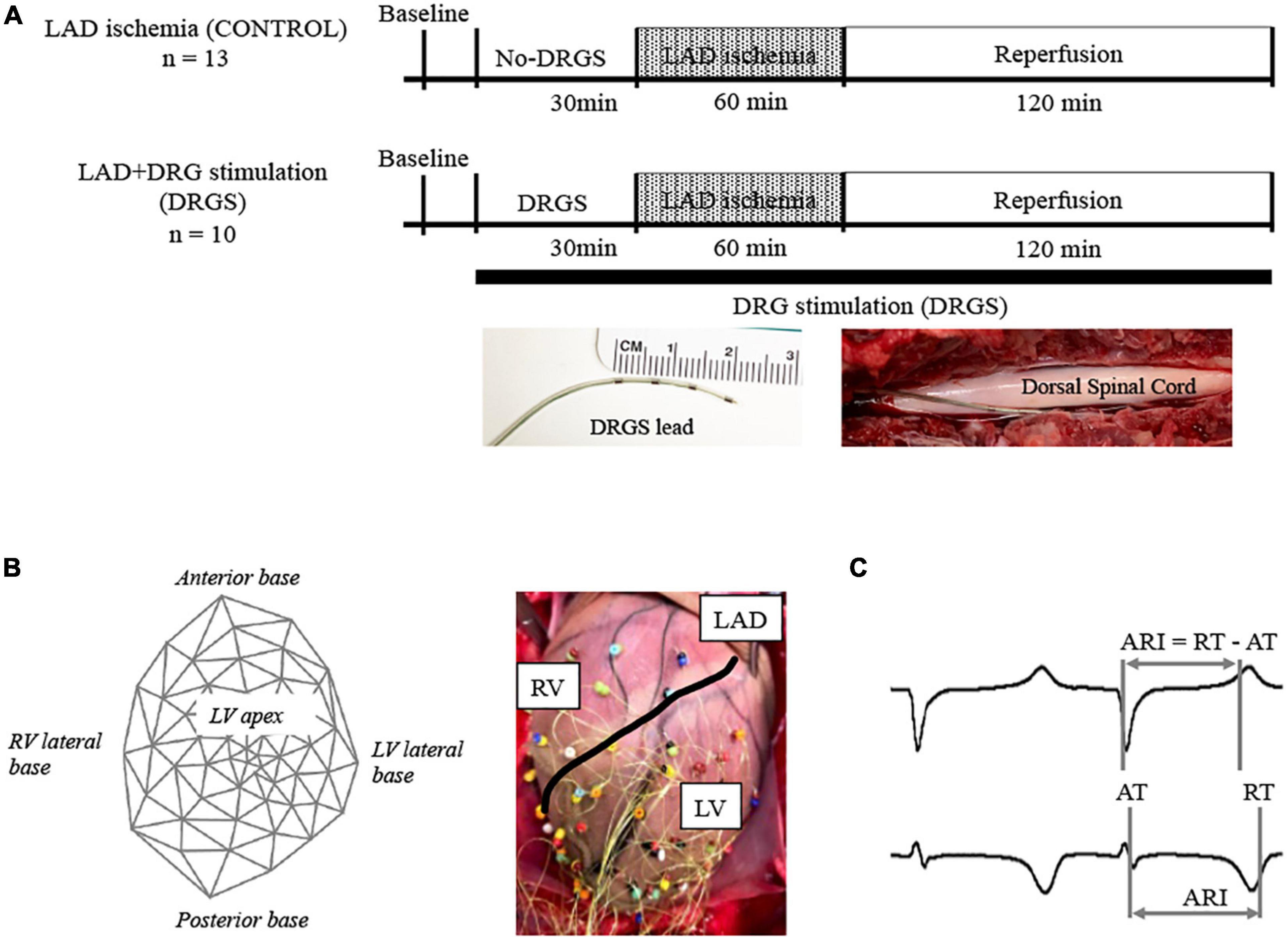 Thoracic dorsal root ganglion stimulation reduces acute myocardial ischemia induced ventricular arrhythmias